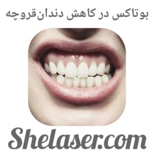 بوتاکس در کاهش دندان‌قروچه