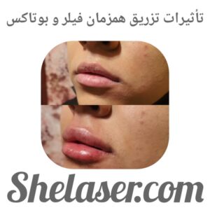 تأثیرات تزریق همزمان فیلر و بوتاکس