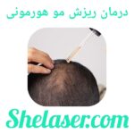 درمان ریزش مو هورمونی