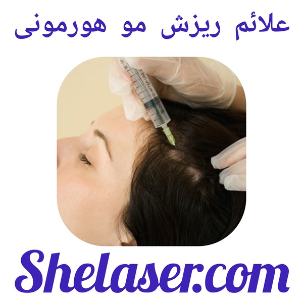 علائم ریزش مو هورمونی