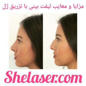 مزایا و معایب لیفت بینی با تزریق ژل