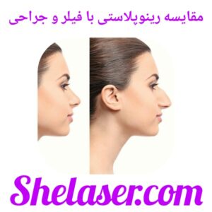 مقایسه رینوپلاستی با فیلر و جراحی