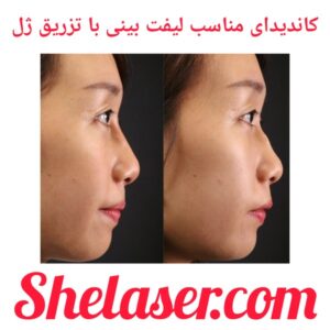 کاندیدای مناسب لیفت بینی با تزریق ژل