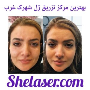 بهترین مرکز تزریق ژل شهرک غرب