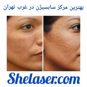 بهترین مرکز سابسیژن در غرب تهران