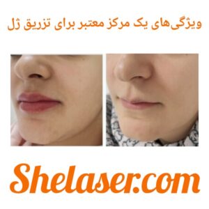 ویژگی‌های یک مرکز معتبر برای تزریق ژل