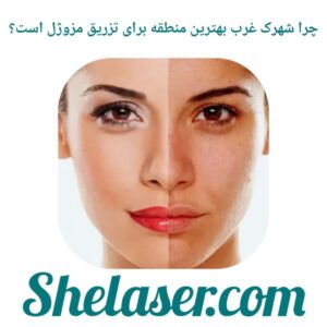 چرا شهرک غرب بهترین منطقه برای تزریق مزوژل است؟