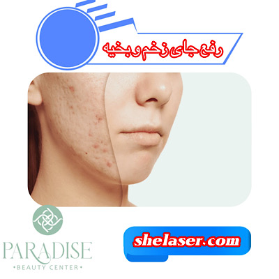 رفع جای زخم و بخیه