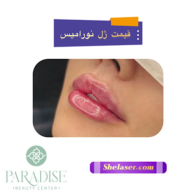 قیمت ژل نورامیس