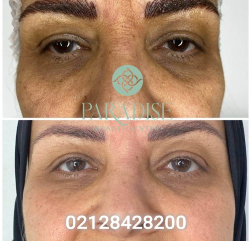 تزریق مزوژل برای رفع مشکلات زیر چشم