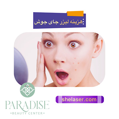 هزینه لیزر جای جوش