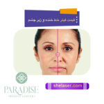قیمت فیلر خط خنده و زیرچشم