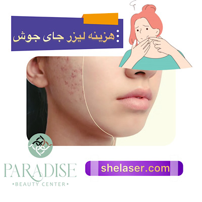 هزینه لیزر جای جوش