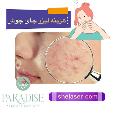 هزینه لیزر جای جوش
