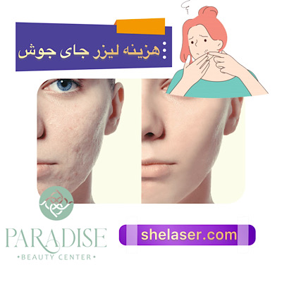 هزینه لیزر جای جوش