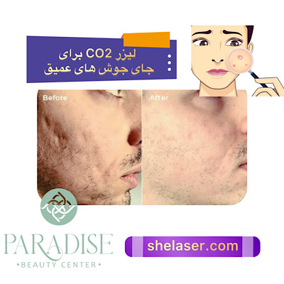 لیزر CO2 برای جای جوش های عمیق