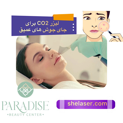 لیزر CO2 برای جای جوش های عمیق