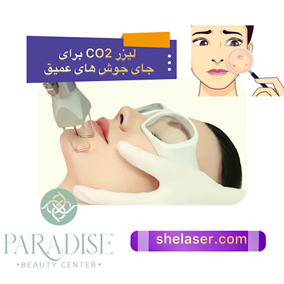 لیزر CO2 برای جای جوش های عمیق