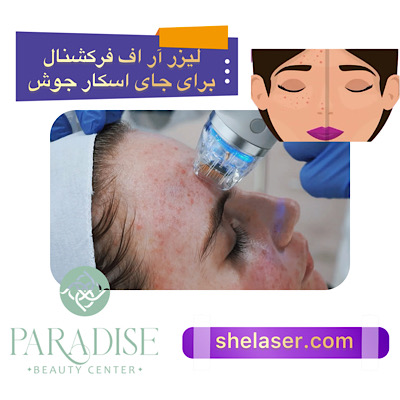 لیزر آر اف فرکشنال برای جای اسکار جوش