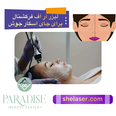 لیزر آر اف فرکشنال برای جای اسکار جوش