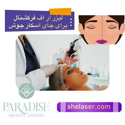 لیزر آر اف فرکشنال برای جای اسکار جوش