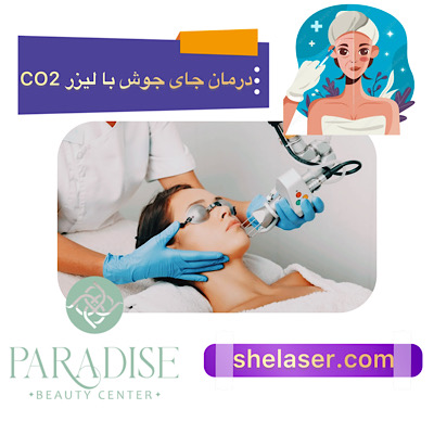 درمان جای جوش با لیزر CO2
