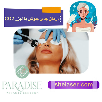 درمان جای جوش با لیزر CO2