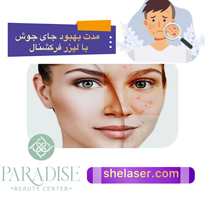 مدت بهبود جای جوش با لیزر فرکشنال 