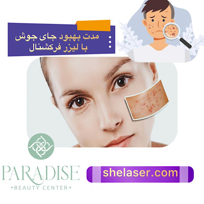 مدت بهبود جای جوش با لیزر فرکشنال 
