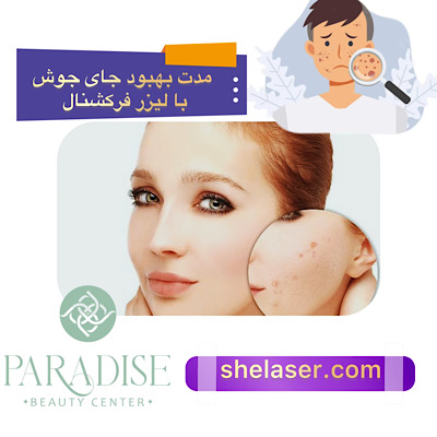 مدت بهبود جای جوش با لیزر فرکشنال