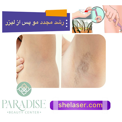 رشد مجدد مو پس از لیزر