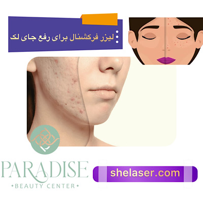 لیزر فرکشنال برای رفع لک