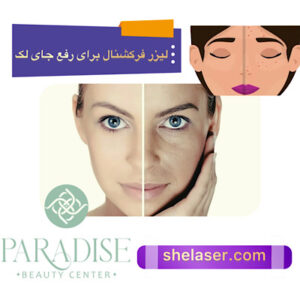 لیزر فرکشنال برای رفع لک