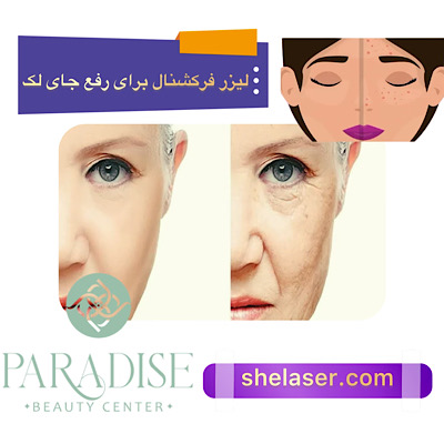 لیزر فرکشنال برای رفع لک