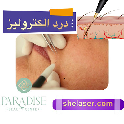 درد الکترولیز