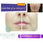 اندولیفت برای خط خنده