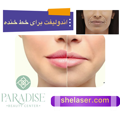 اندولیفت برای خط خنده