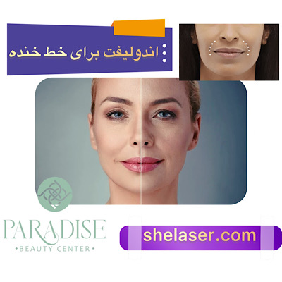 اندولیفت برای خط خنده