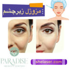 مزوژل زیر چشم
