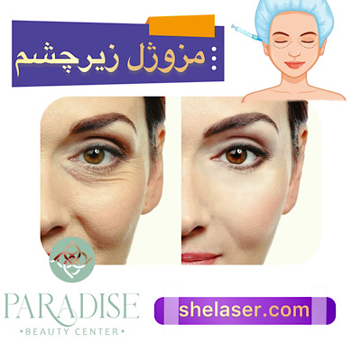 مزوژل زیر چشم