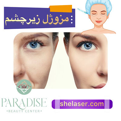 مزوژل زیر چشم
