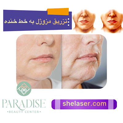 تزریق مزوژل به خط خنده