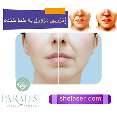 تزریق مزوژل به خط خنده