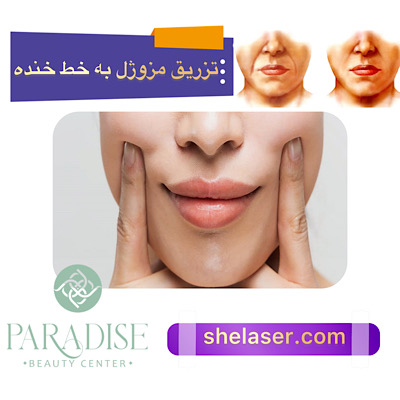 تزریق مزوژل به خط خنده