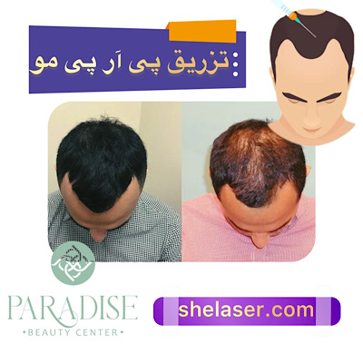 تزریق PRP مو