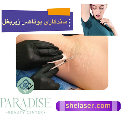 ماندگاری بوتاکس زیر بغل
