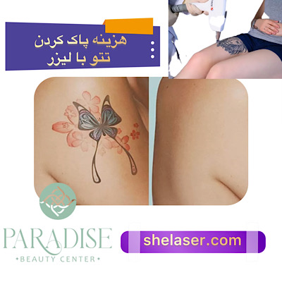 هزینه پاک کردن تاتو با لیزر