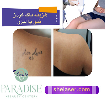 هزینه پاک کردن تاتو با لیزر