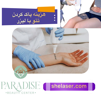 هزینه پاک کردن تاتو با لیزر