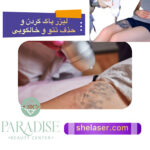 لیزر پاک کردن و حذف تاتو و خالکوبی
